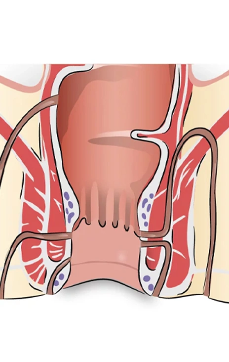 Fistula Surgery